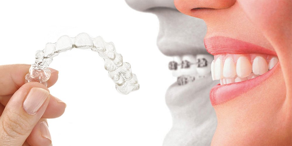 M-aligner