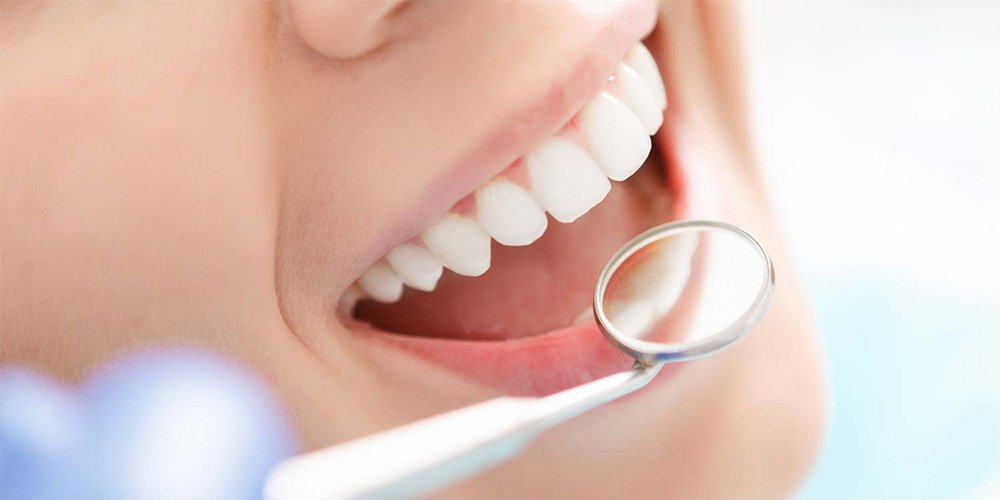 veneers